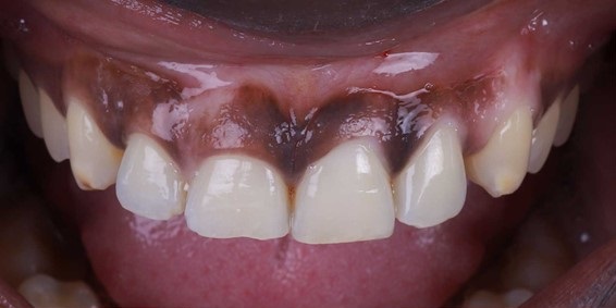 antes